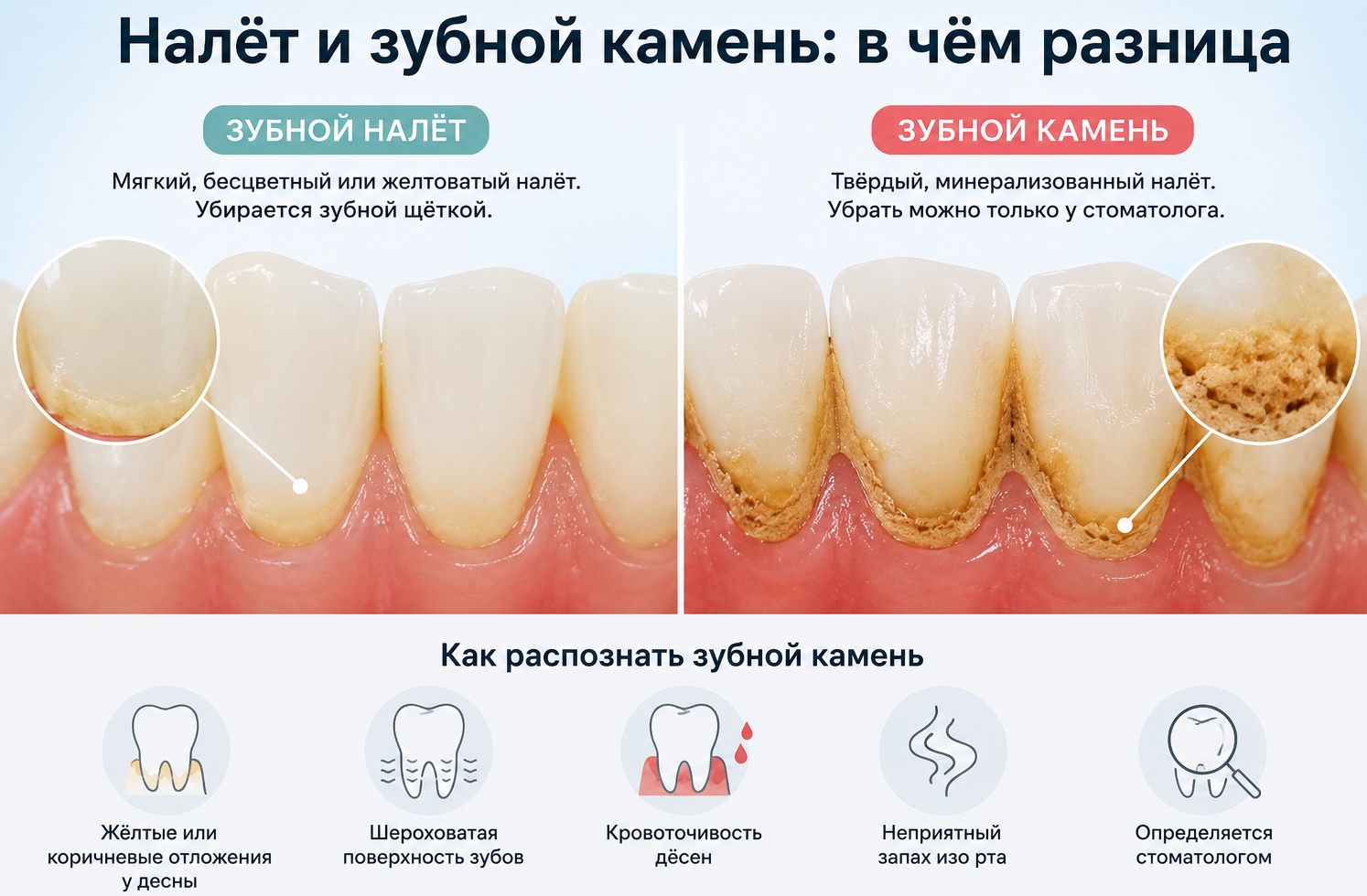 зубной налёт уже превратился в зубной камень