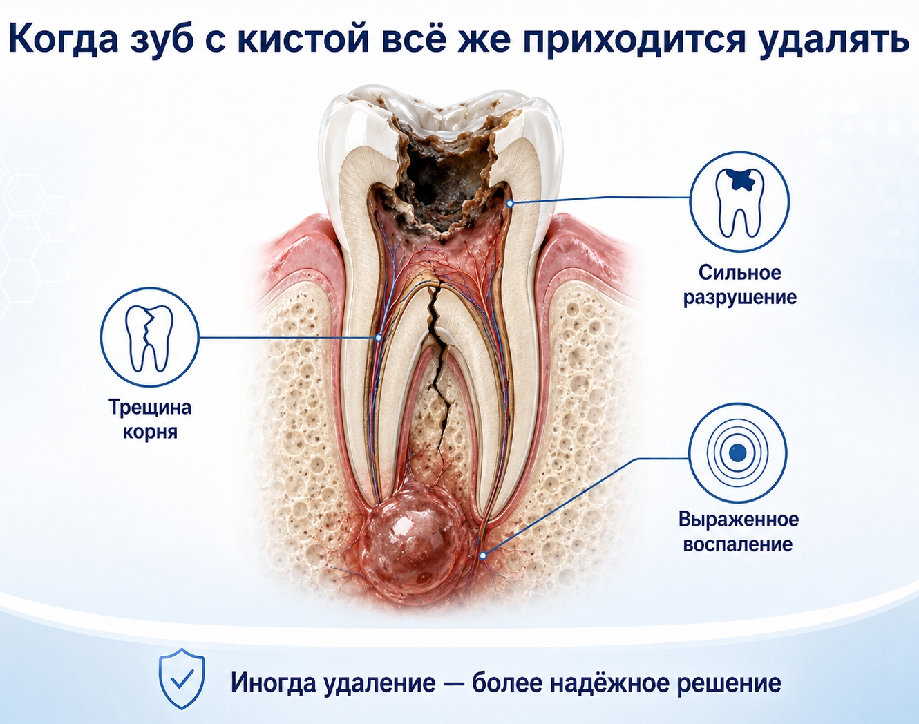 Когда зуб с кистой всё же приходится удалять