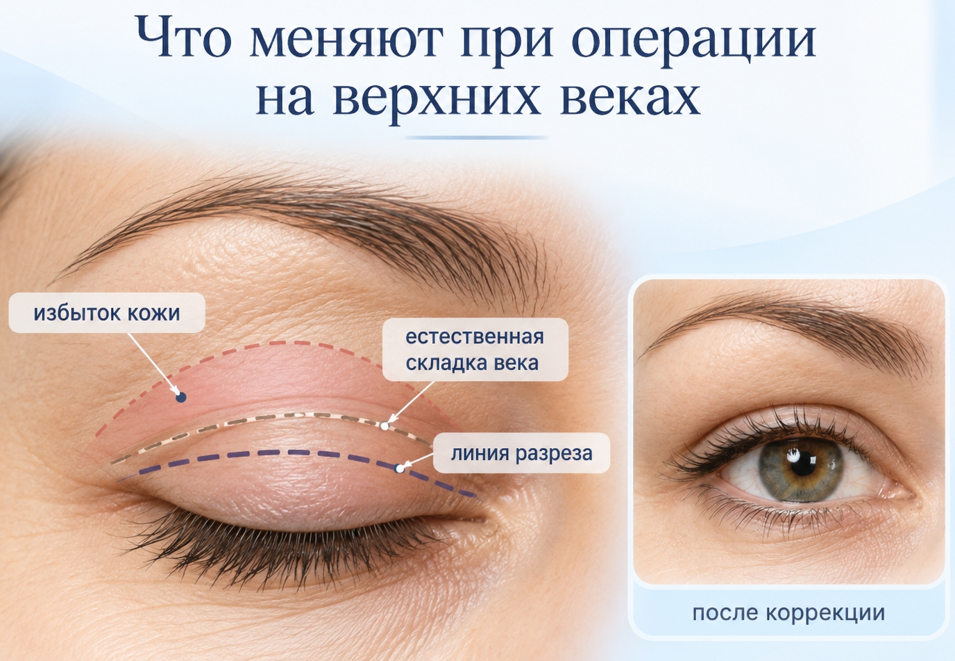 Что меняют при операции на верхних веках